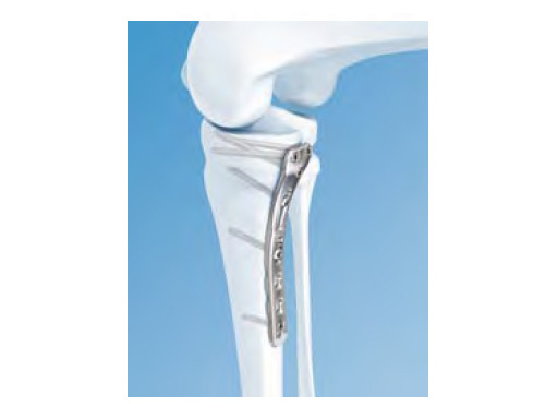 3-5LCPPosteromedialProximalTibiaPlate_2