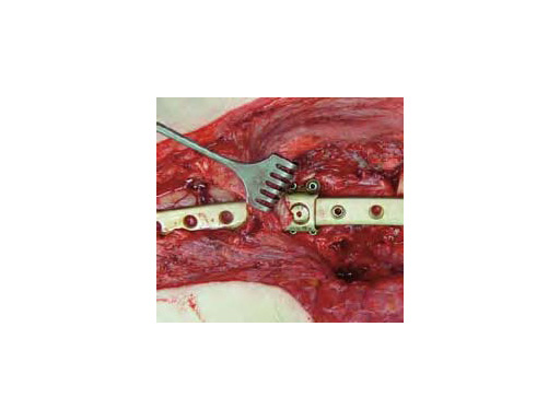3-5LockingAttachmentPlate_5