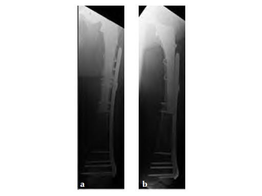 3-5LockingAttachmentPlate_6