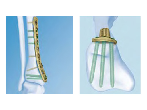 3-5mmLCPLowBendMedialDistalTibia_2