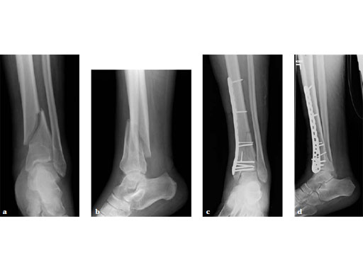 3-5mmLCPLowBendMedialDistalTibia_3