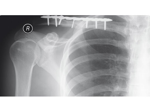 3-5mmLCPSuperiorClavicle_10