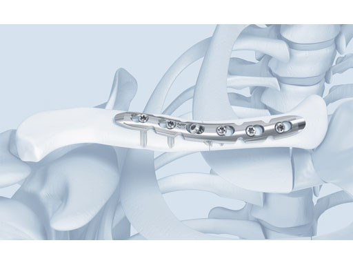 3-5mmLCPSuperiorClavicle_4