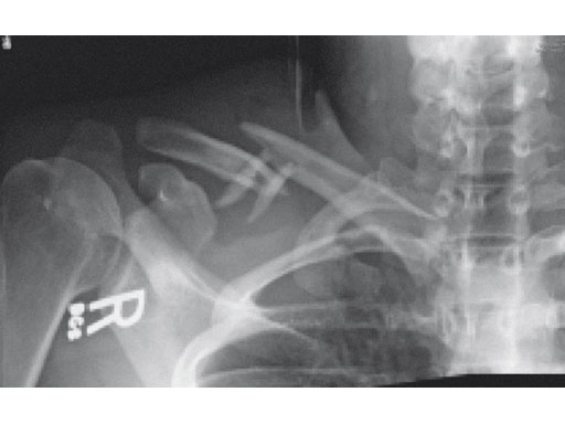 3-5mmLCPSuperiorClavicle_5