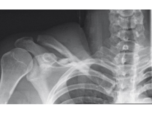3-5mmLCPSuperiorClavicle_6