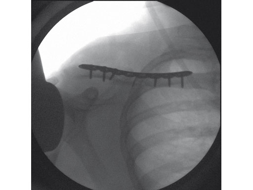 3-5mmLCPSuperiorClavicle_7