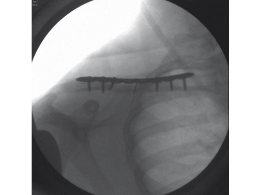 3-5mmLCPSuperiorClavicle_8