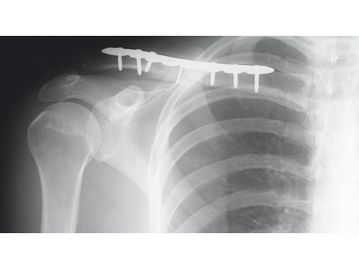 3-5mmLCPSuperiorClavicle_9