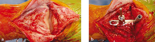 4-5mmLCPnarrowandbroad_Fig2ab