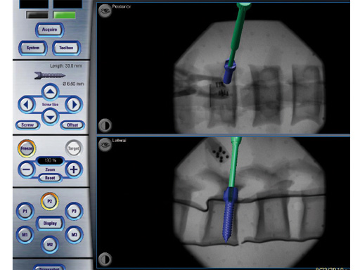 computer-ass-spinal-surgery-02