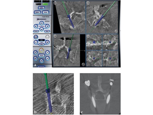 computer-ass-spinal-surgery-03