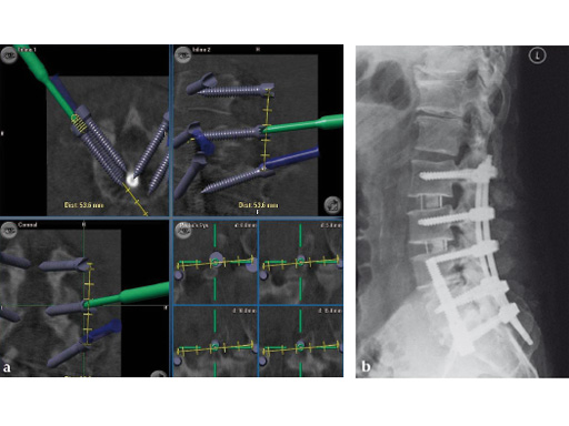 computer-ass-spinal-surgery-06