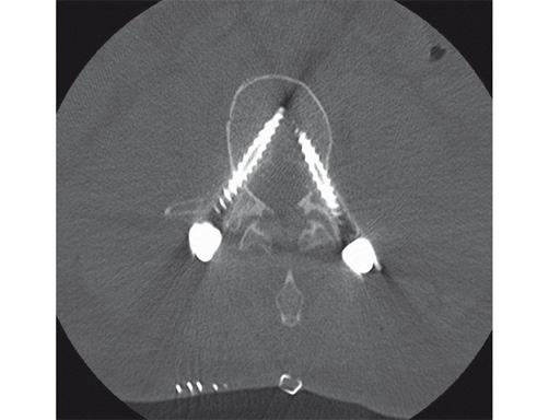 computer-ass-spinal-surgery-08