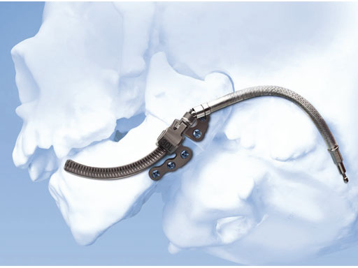 Curvilinear Distractor 2.0 mm