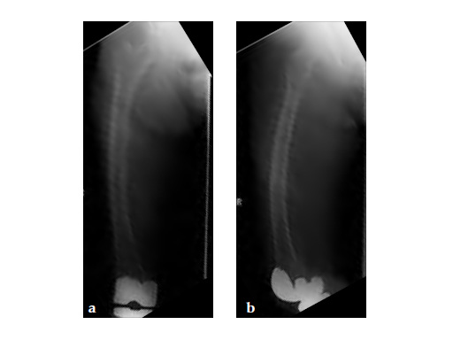 ExpertAsianFemoralNailA2FN_10