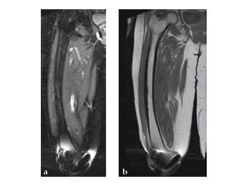 ExpertAsianFemoralNailA2FN_11