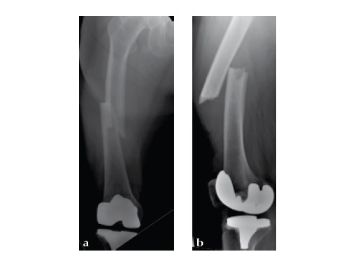 ExpertAsianFemoralNailA2FN_12