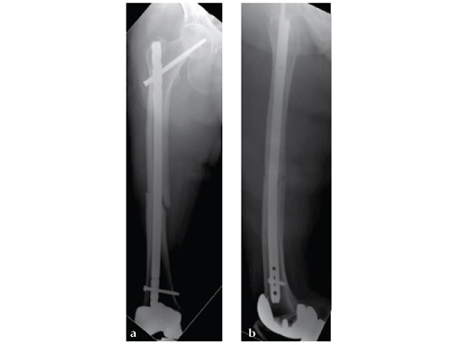 ExpertAsianFemoralNailA2FN_13