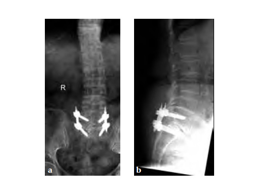 ExpertAsianFemoralNailA2FN_9