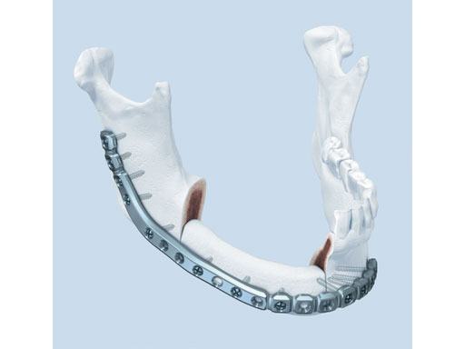 MatrixMandibleSystemPrefReconstrPlate_1
