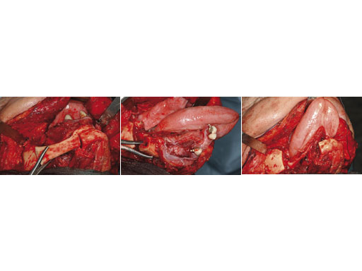 MatrixMandibleSystemPrefReconstrPlate_10