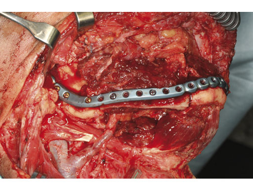 MatrixMandibleSystemPrefReconstrPlate_11