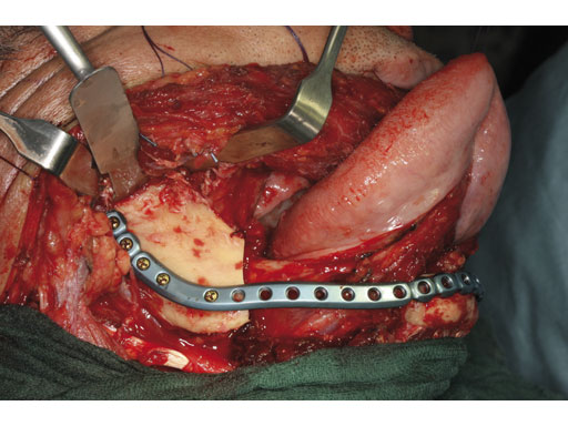 MatrixMandibleSystemPrefReconstrPlate_12