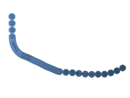 MatrixMandibleSystemPrefReconstrPlate_5