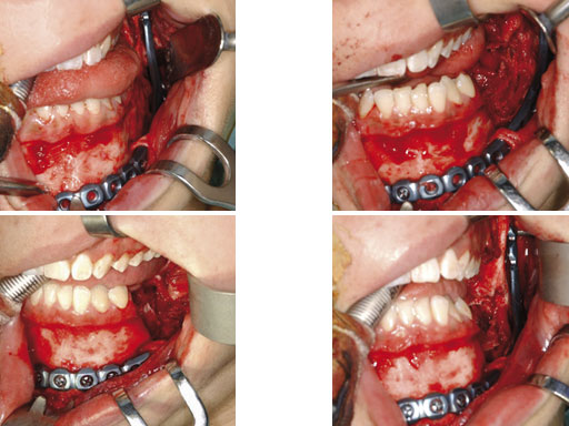 MatrixMandibleSystemPrefReconstrPlate_6