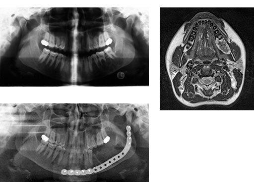 MatrixMandibleSystemPrefReconstrPlate_7