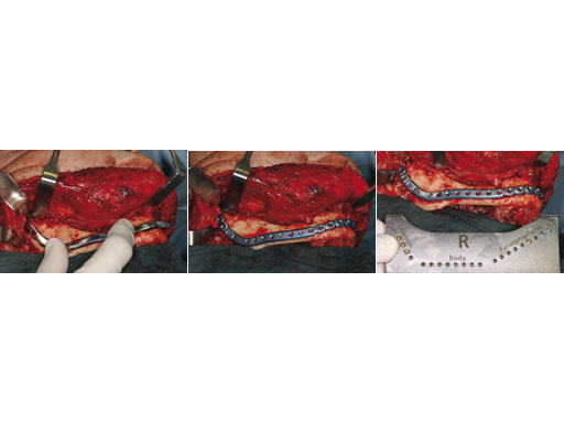 MatrixMandibleSystemPrefReconstrPlate_9