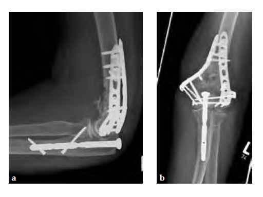 OlecranonOsteotomyNail_5