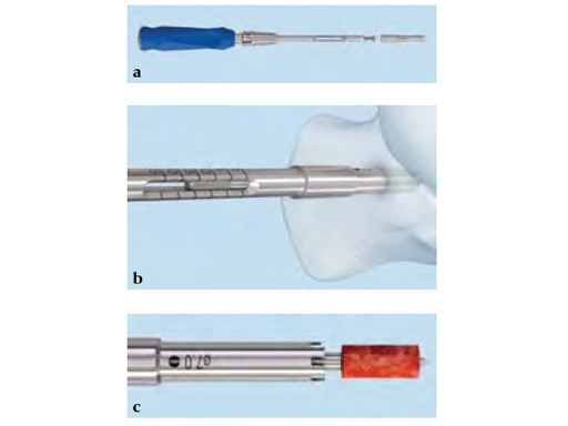 OrthopaedicFootInstrumentSet_3