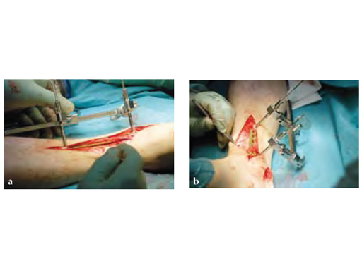 OrthopaedicFootInstrumentSet_4