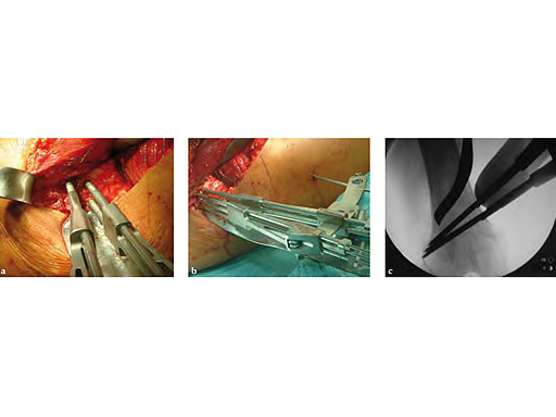 OsteotomyGuidingDevice_3