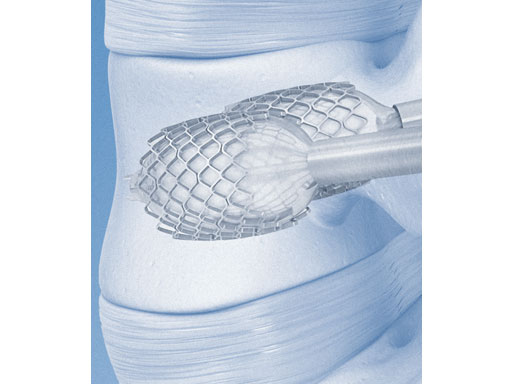 VertebralBodyStent_1