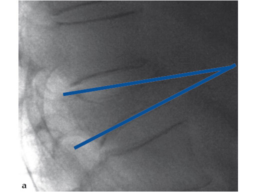 VertebralBodyStent_4