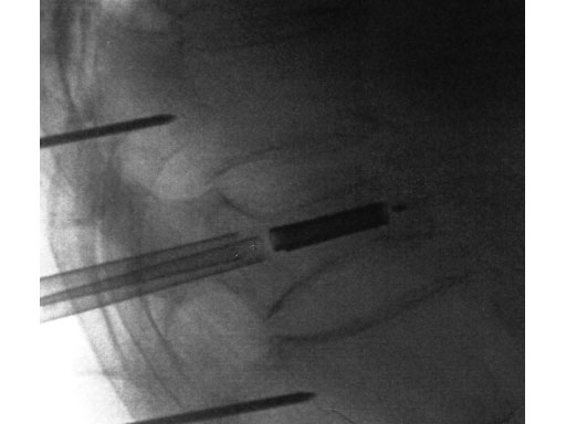 VertebralBodyStent_5