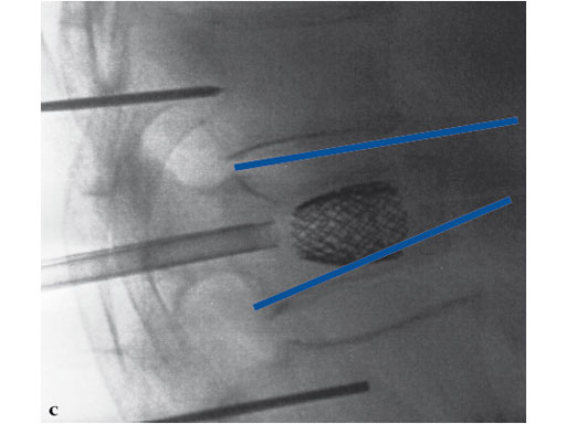 VertebralBodyStent_6
