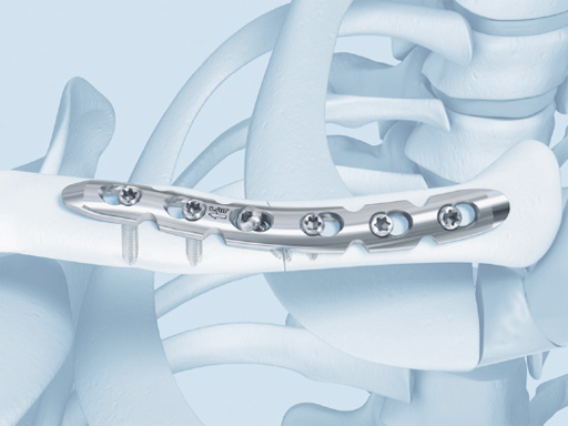 02-fractures-clavicle-05