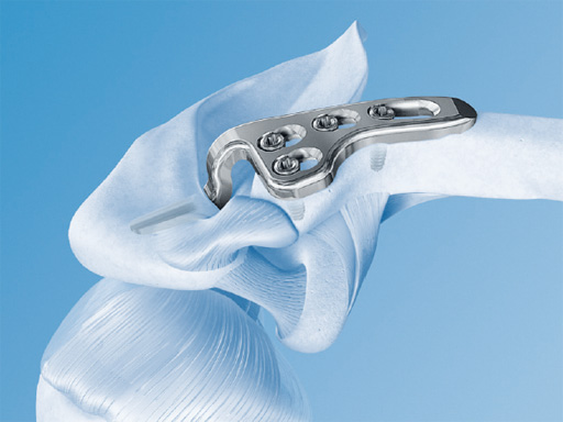 02-fractures-clavicle-06