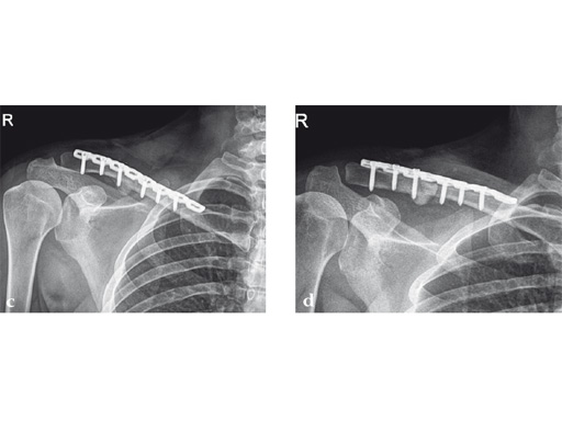 02-fractures-clavicle-09