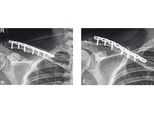 02-fractures-clavicle-10