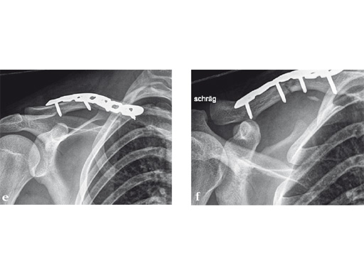 02-fractures-clavicle-15