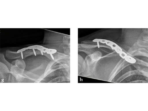 02-fractures-clavicle-16