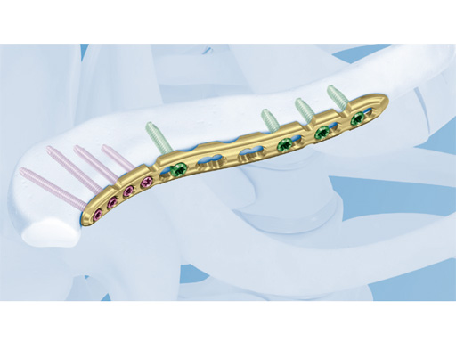 05-2-7-3-5-VA-LCP-Anterior-Clavicle-01