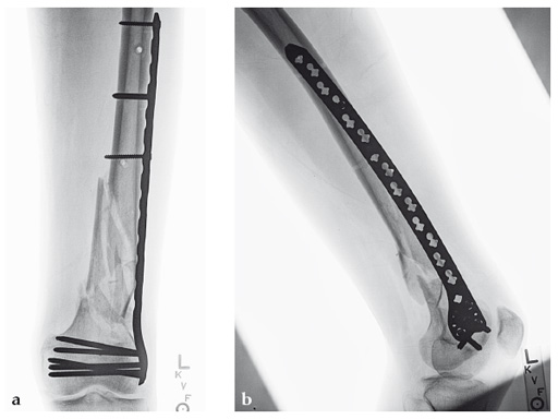 Fig 2a-b Six-week follow-up: AP (a) and lateral (b) x-rays.
