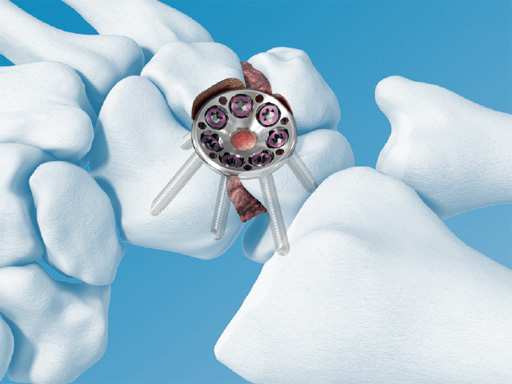 2-4-VA-Locking-Intercarpal-Fusion-System-01
