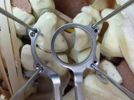 2-4-VA-Locking-Intercarpal-Fusion-System-05
