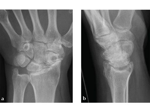 2-4-VA-Locking-Intercarpal-Fusion-System-07